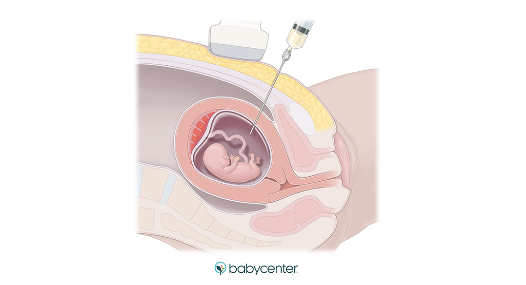 illustration showing an amnio needle gathering fluid from inside a womb