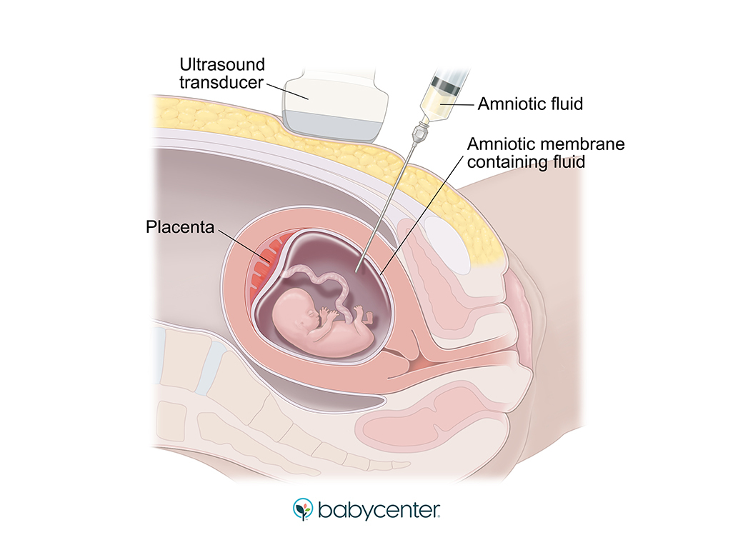 illustration showing ultrasound guided amnio