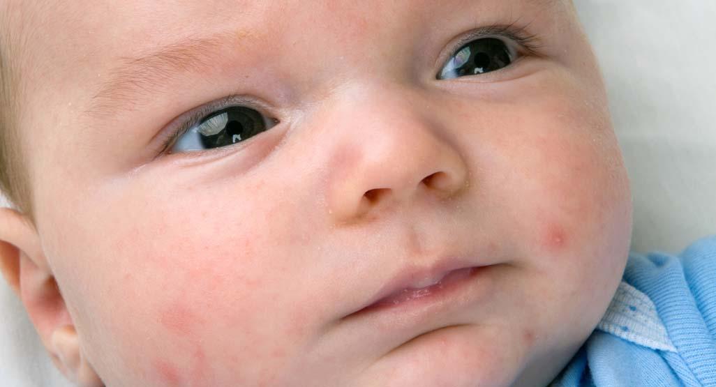 baby's face with acne spots
