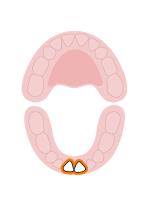 illustrated image of caries on lower central incisors