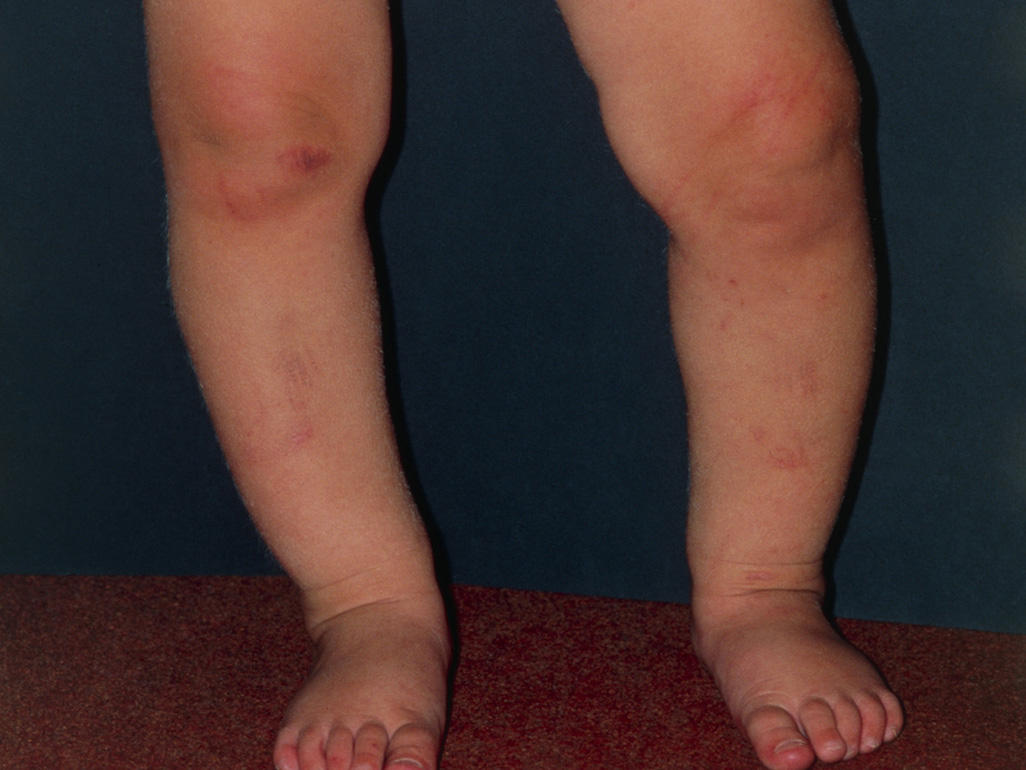 Bowlegs 12 A 24 Mo Centre Maman