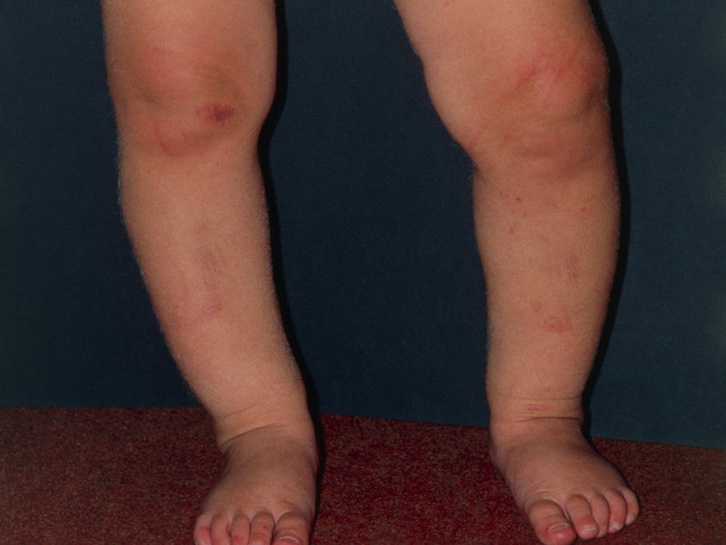 baby legs standing, with feet closer together than knees