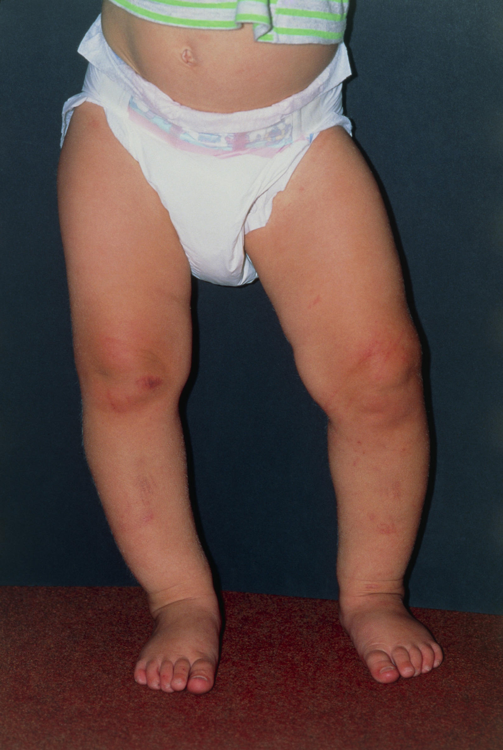 baby legs standing, with feet closer together than knees