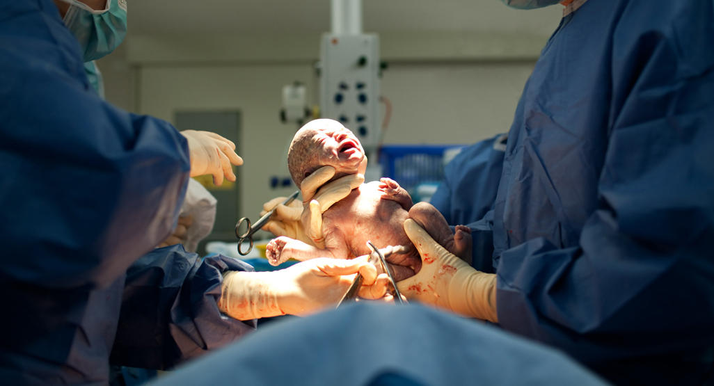 doctors cutting the umbilical cord of a newborn baby