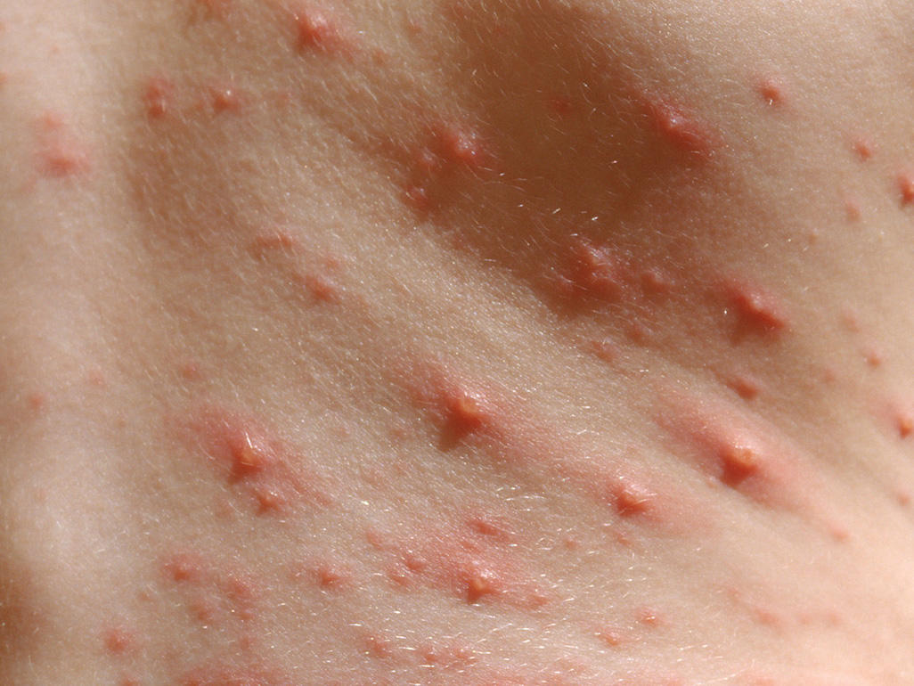 close-up of skin with pink spots with raised bumps