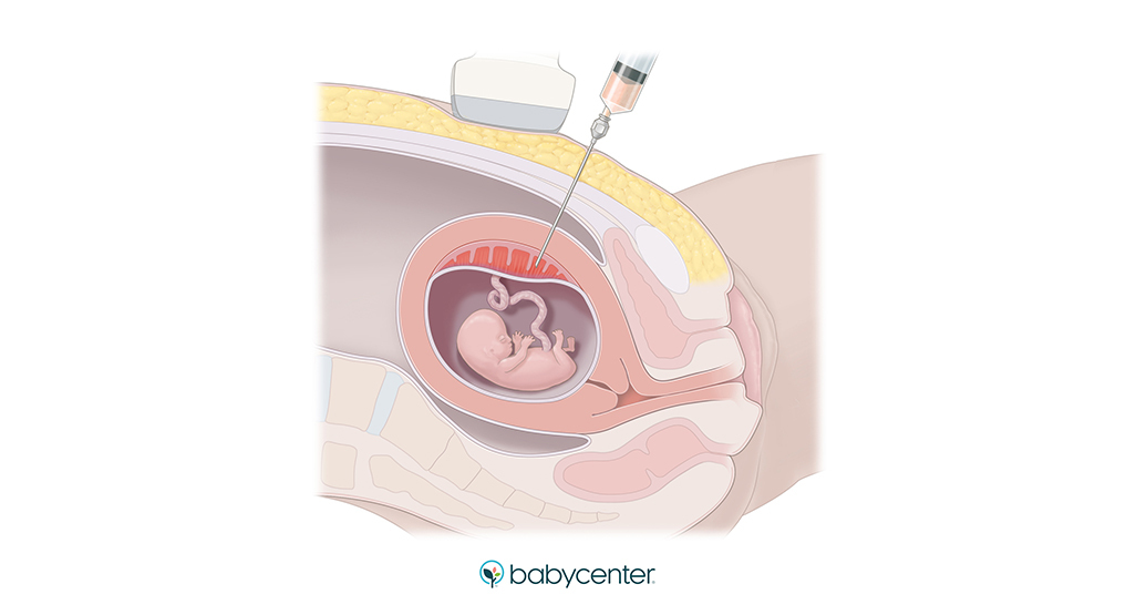 illustration showing a needle being inserted into the womb while performing a Chorionic villus sampling