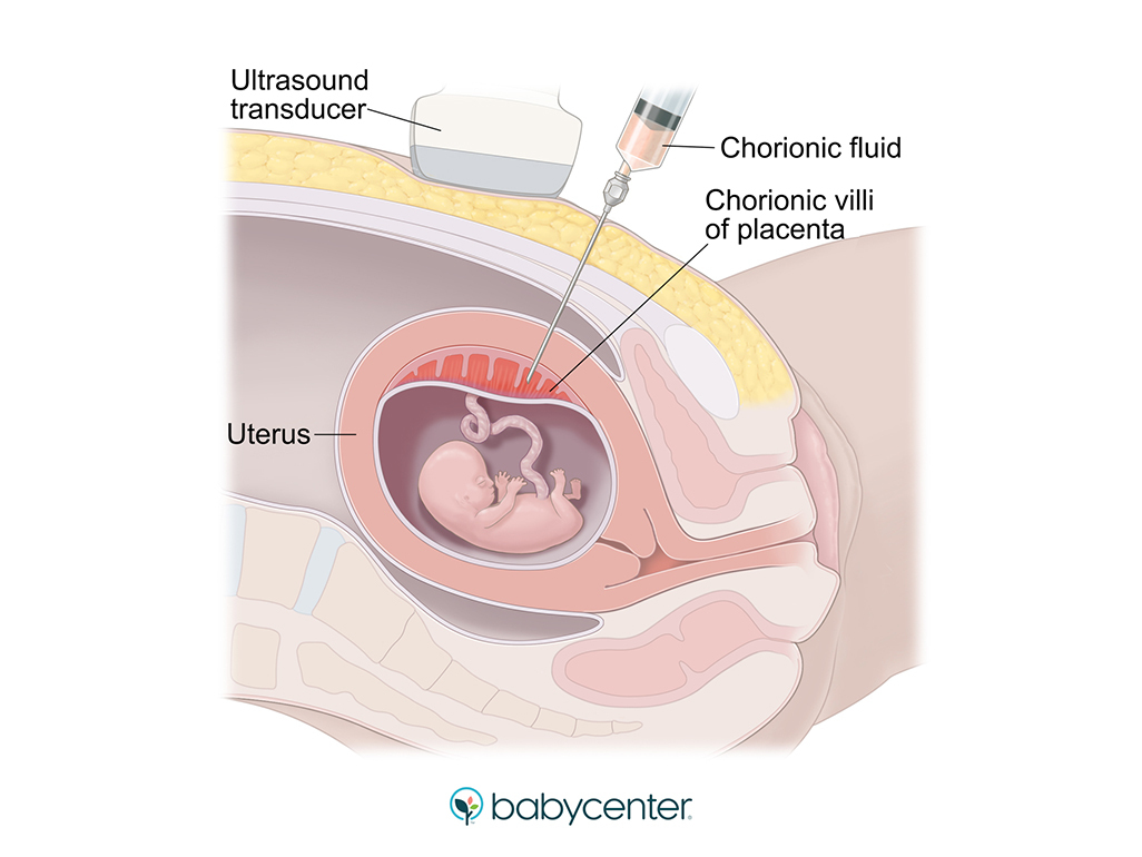 illustration of a needle being inserted into the womb for a cvs procedure