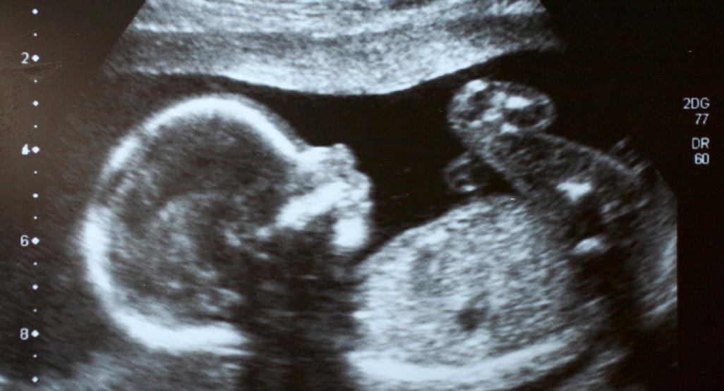 ultrasound picture of baby in womb