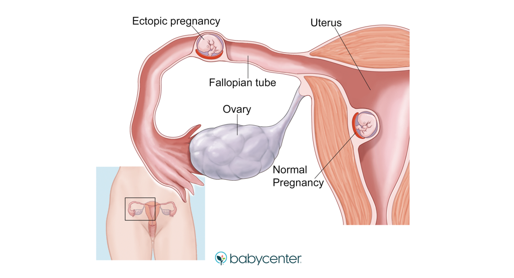 illustration showing an ectopic pregnancy
