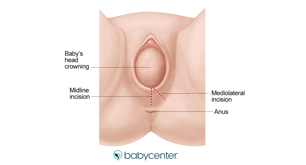 medical illustration of midline and mediolateral episiotomy