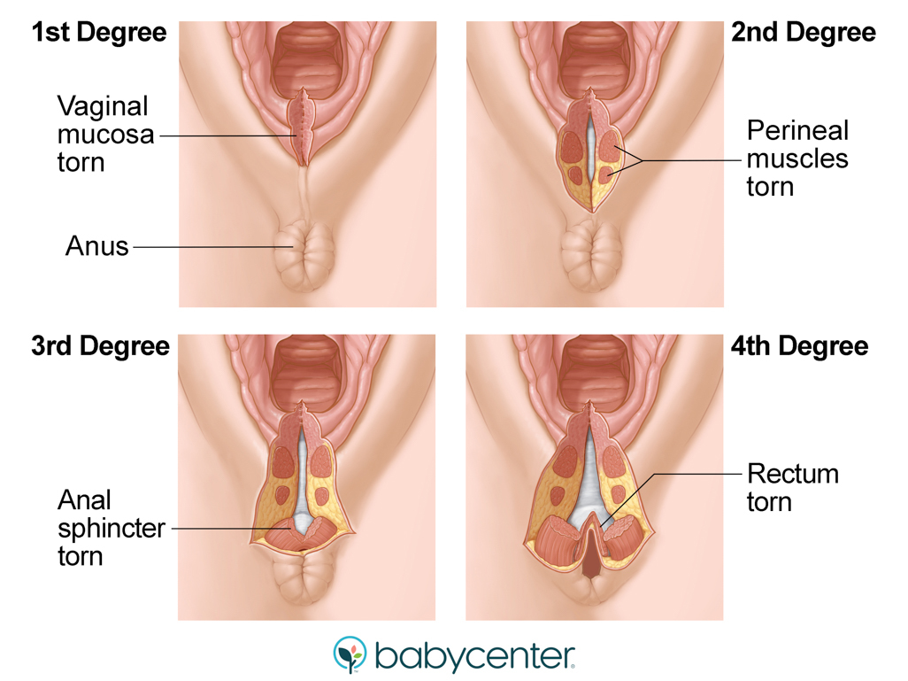 illustration of four types of perineal tears