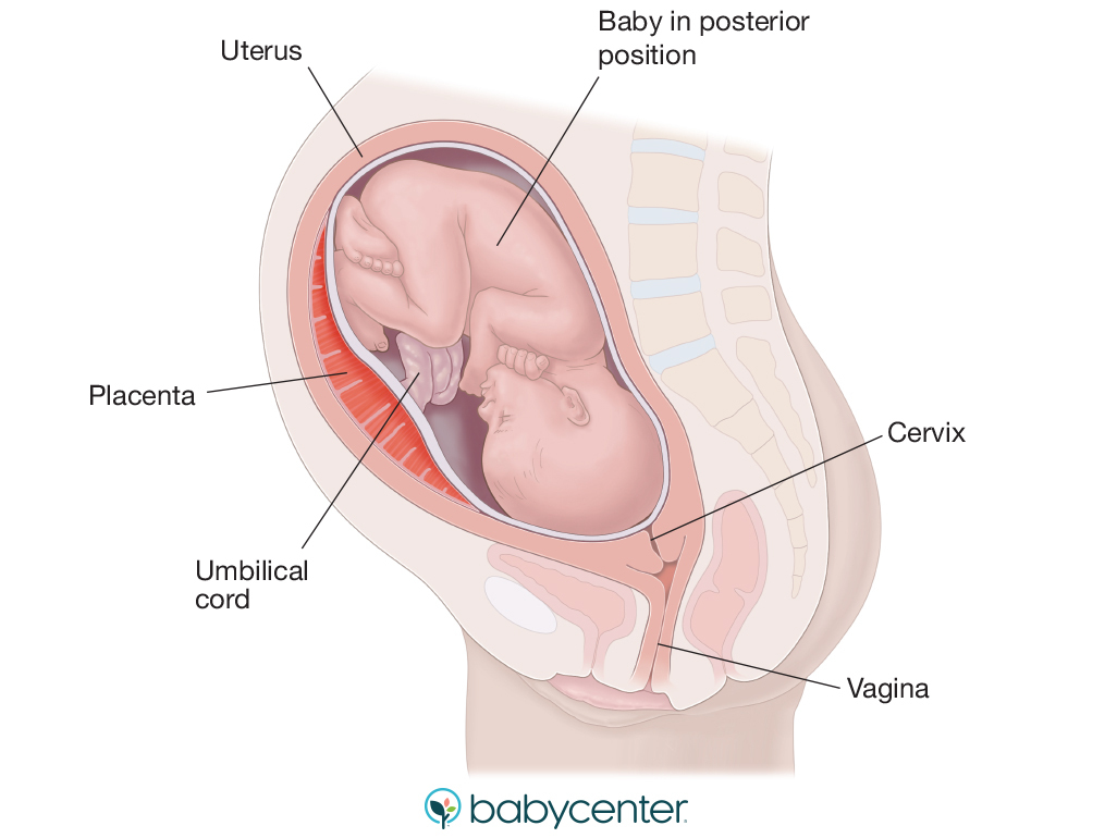illustration of a baby in the posterior position in the womb