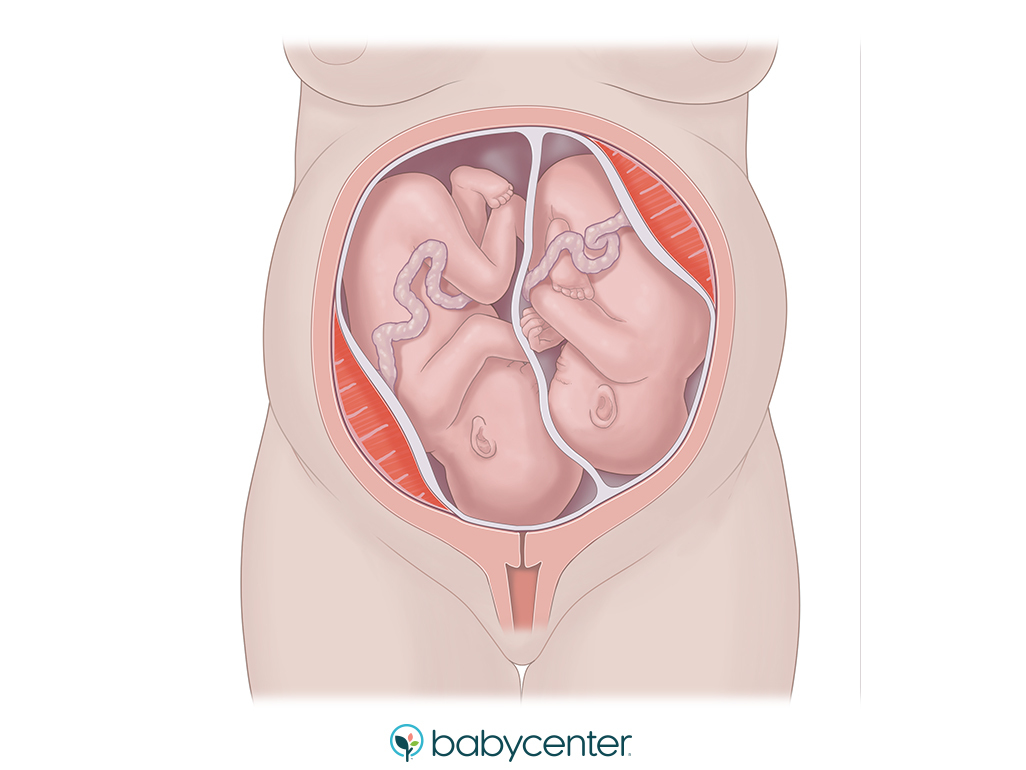 illustration of twin babies head down in utero