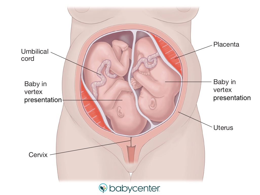 illustration of twin babies each in the vertex position in utero