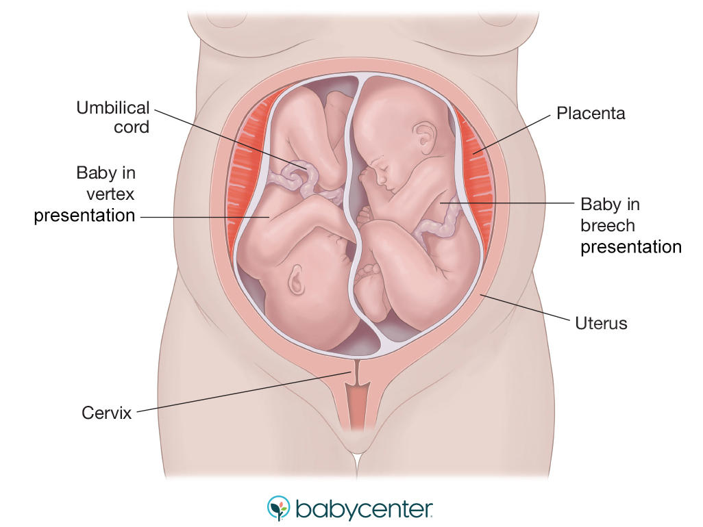 illustration of twins in utero one is head down and one is breech