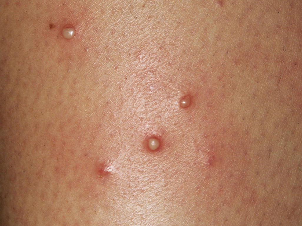a few small raised bumps with white tops and smaller red circles