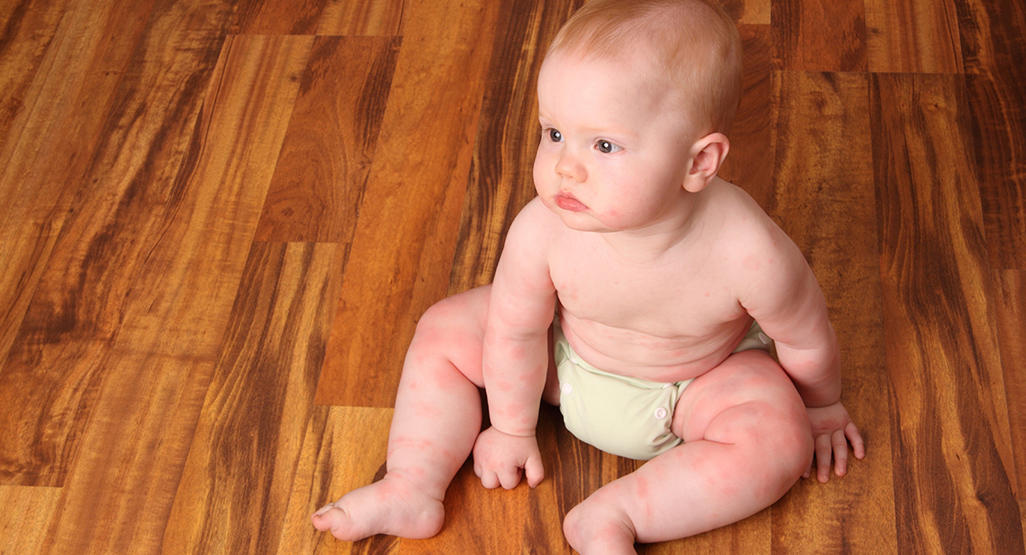 baby sitting in diaper with areas of pink skin
