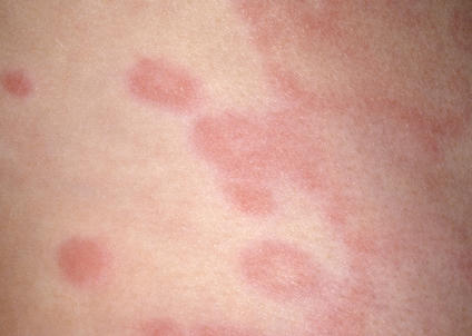 skin with large pink patches, some connected together