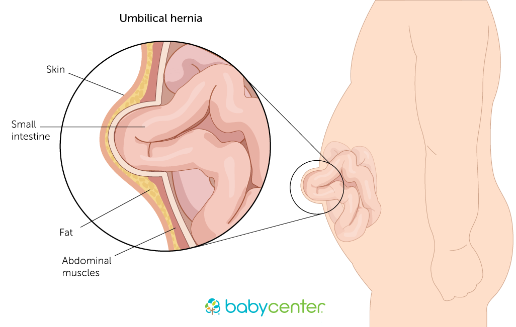 illustration of an umbilical hernia