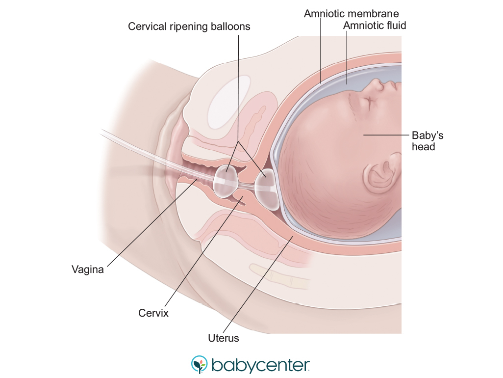 diagram of cervical ripening balloons inserted through the cervix
