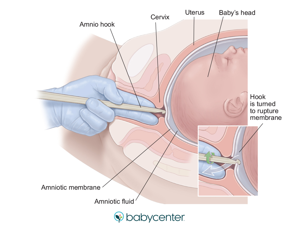 diagram of an amnio hook inserted through the cervix