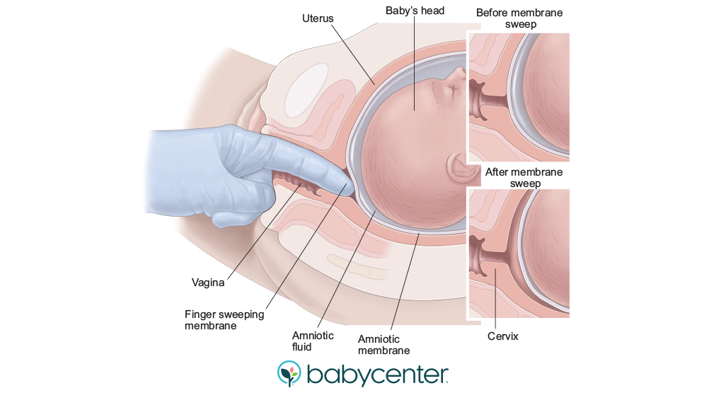 medical illustration of membrane sweeping to induce labor