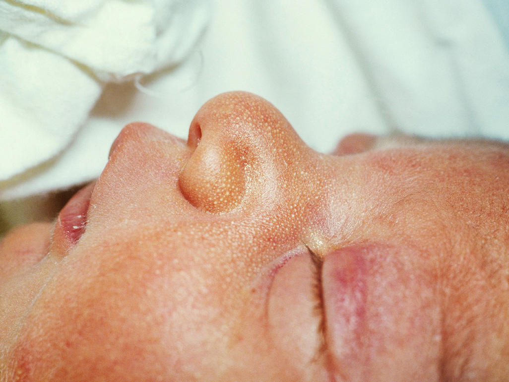 Milia Sur Le Visage Le Nez Les Joues Et La Peau Du Nouveau Ne Centre Maman Milia Sur Le Visage Le Nez Les Joues Et La Peau Du Nouveau Ne Centre Maman