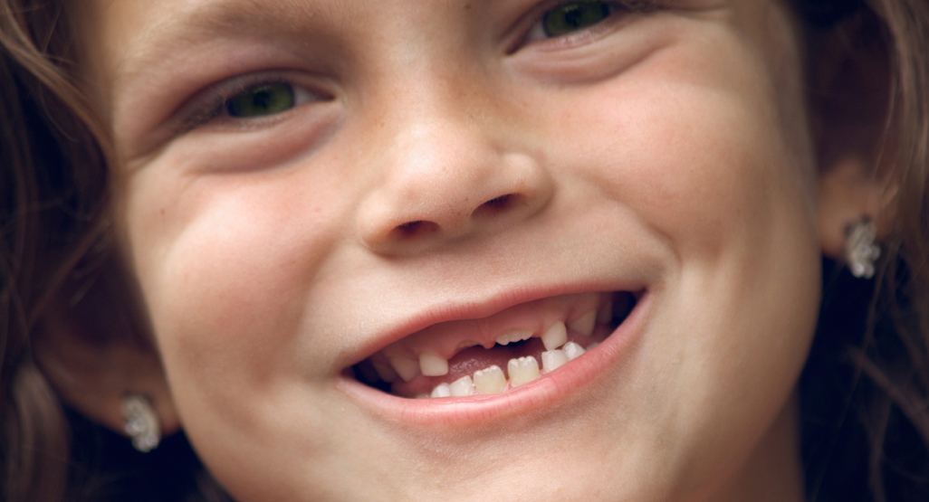 girl smiling with missing front teeth