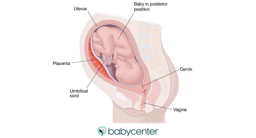 diagram of baby in posterior position, showing position of placenta, umbilical cord, uterus, and cervix