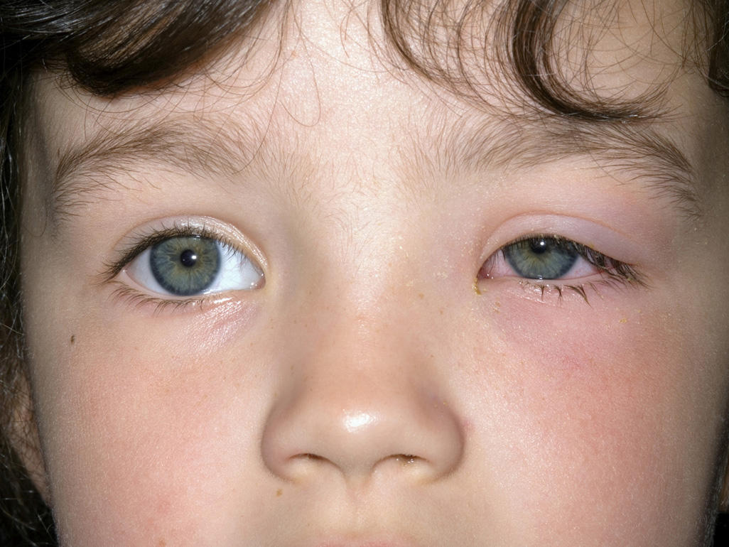 child with one eye pink and swollen partially shut
