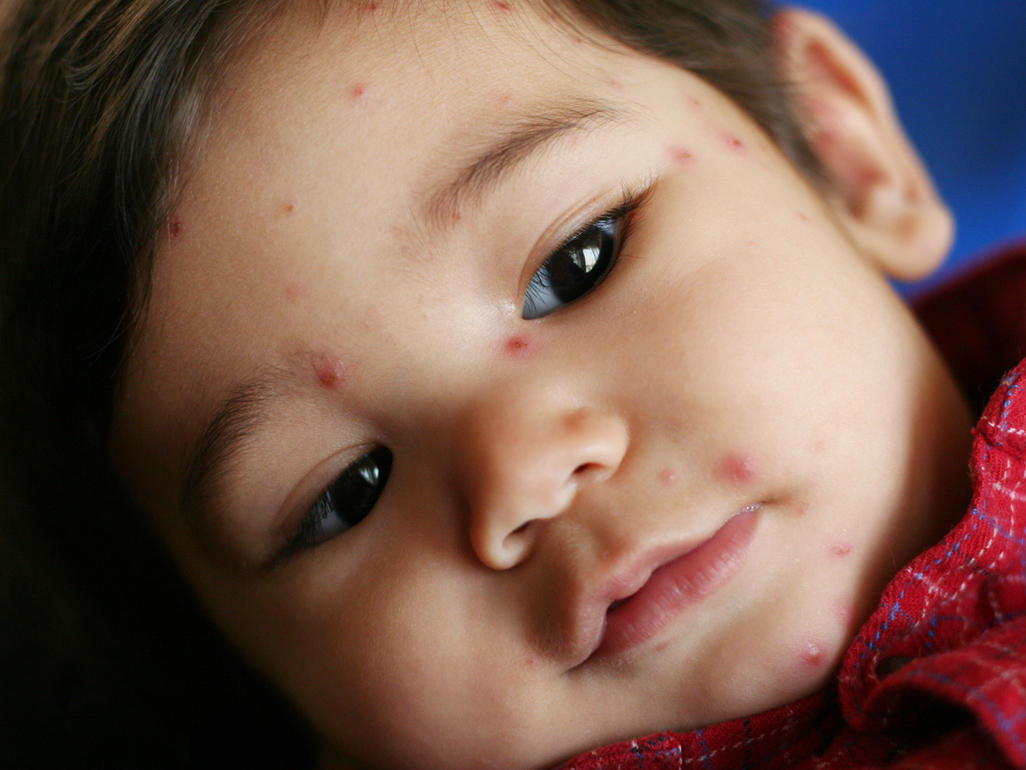 little boy with chickenpox (varicella)