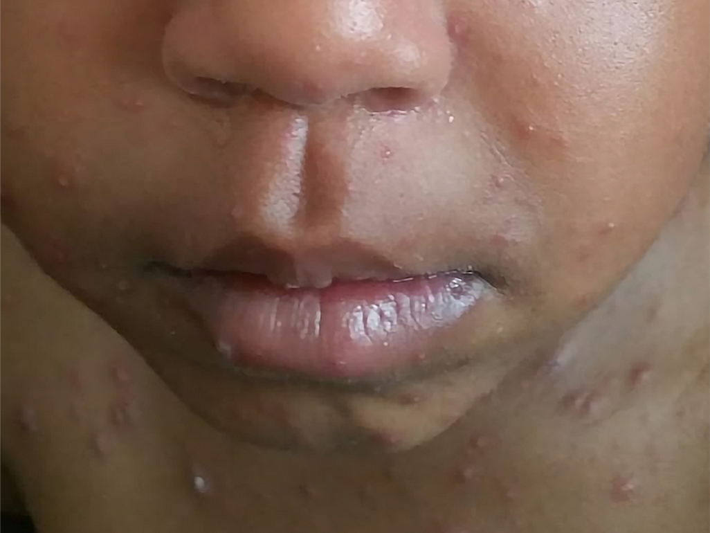 chicken pox on brown skin