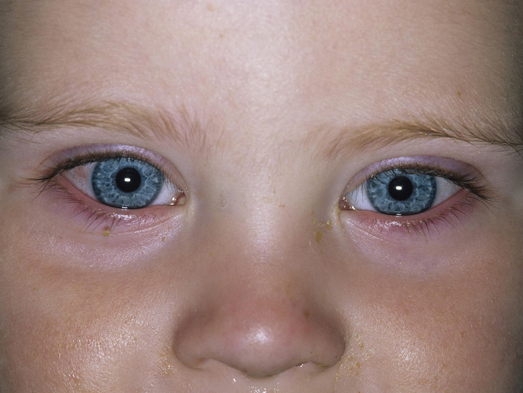 child with swollen and red eyes