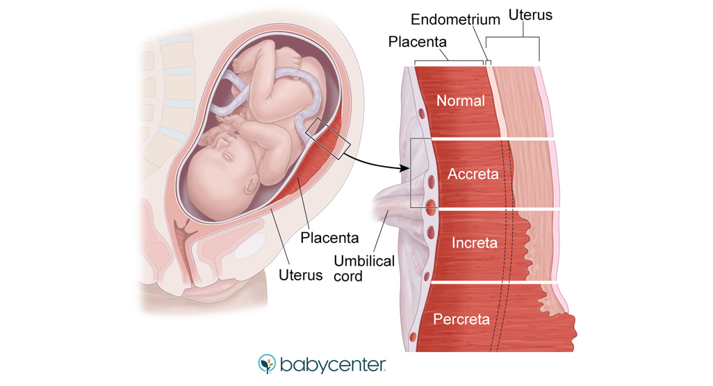 medical illustration of placenta accreta, increta, and percreta