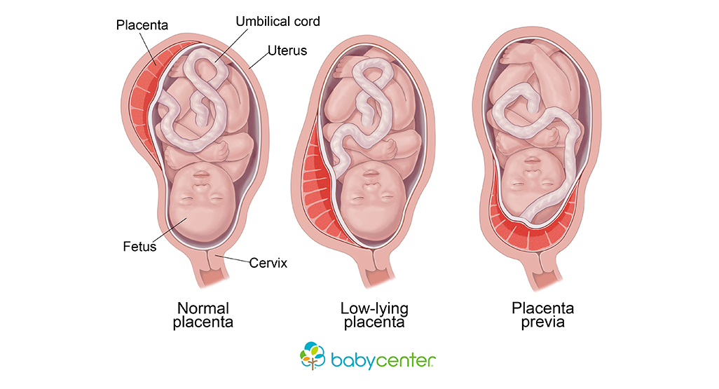medical illustration showing 3 different placenta positions in the womb