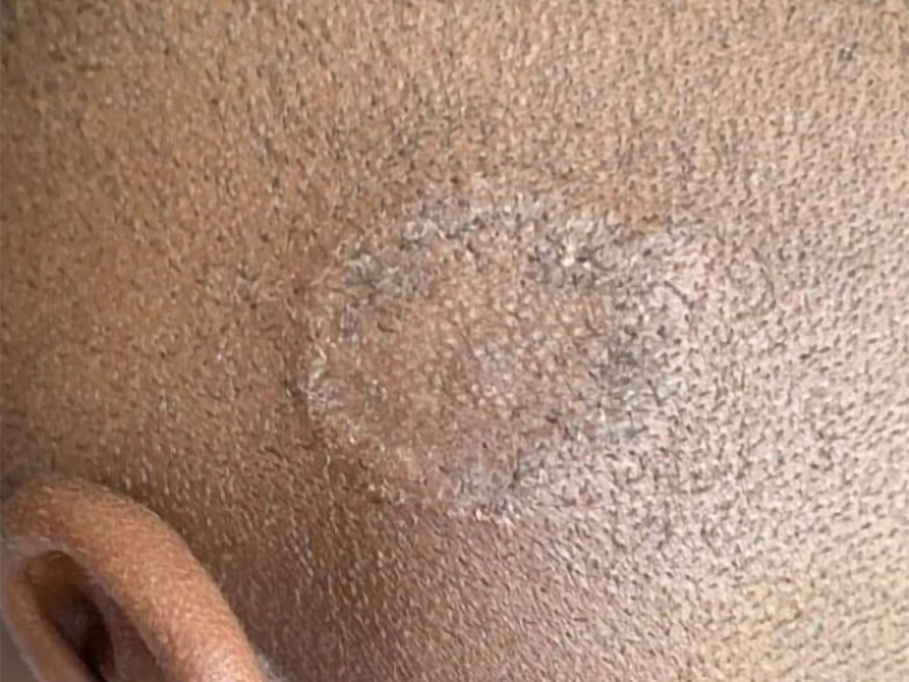 child with ringworm on the scalp