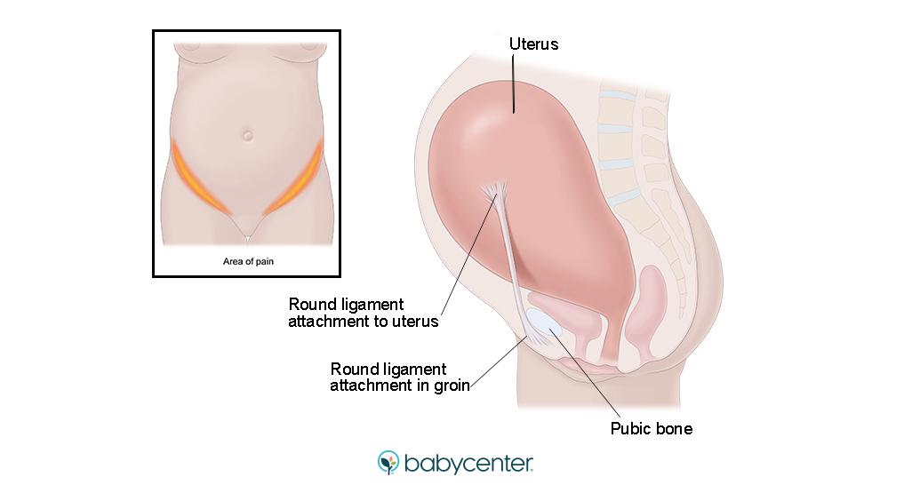 medical illustration of round ligament and where it causes pain during pregnancy