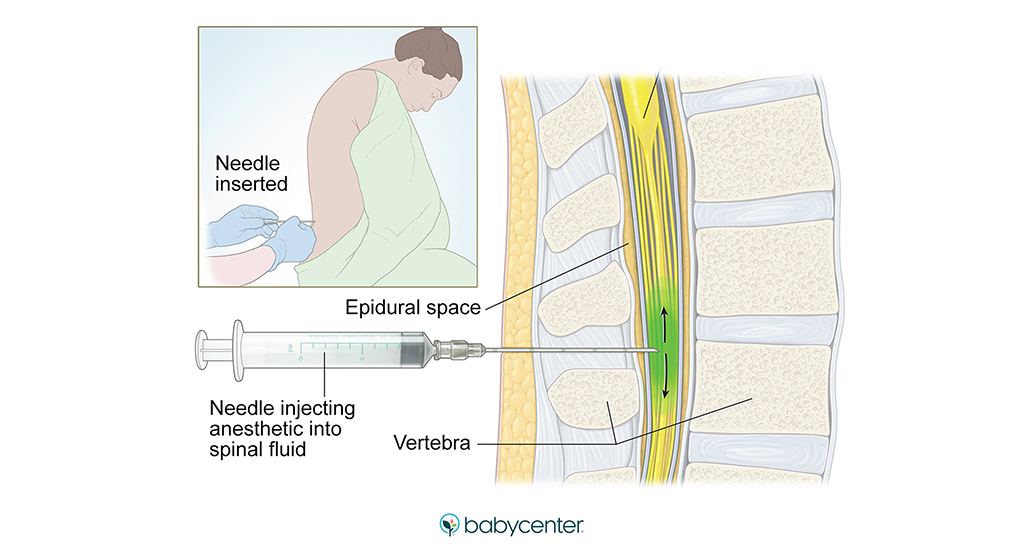illustration showing how a spinal block is done