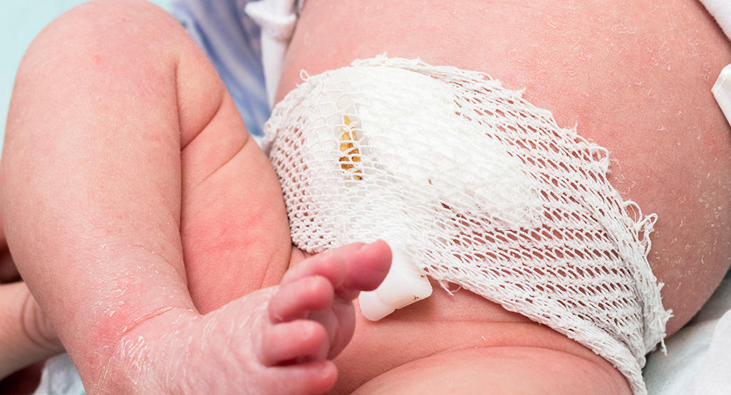 newborn child wrapped around belly button