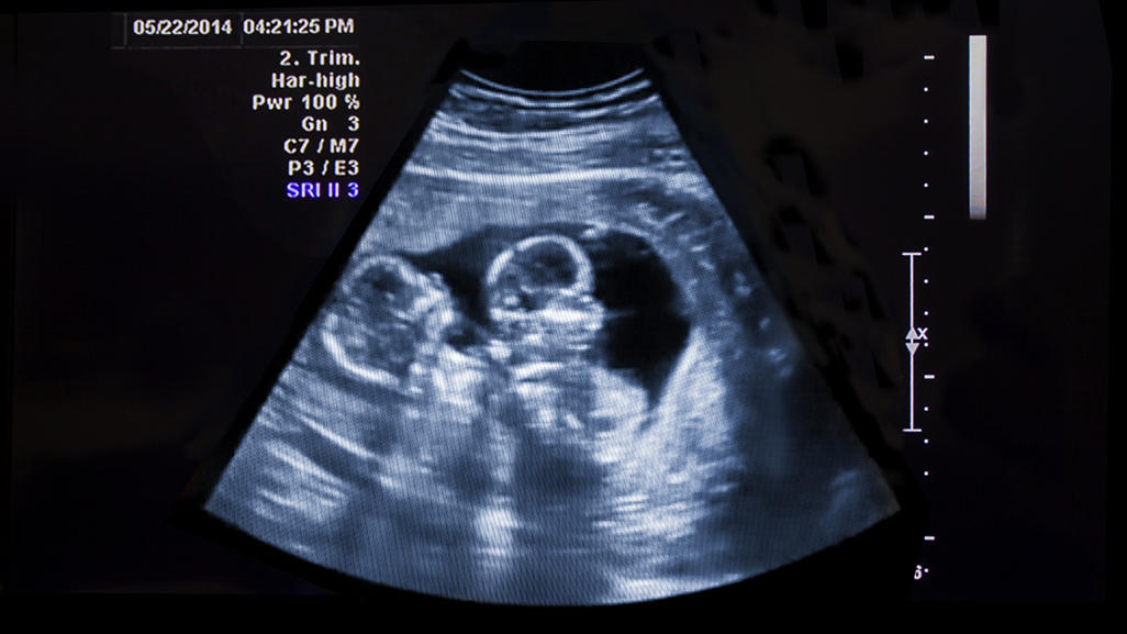 ultrasound photo showing twin babies