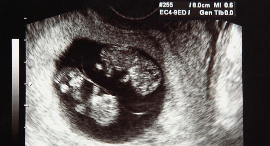 ultrasound photo showing twin babies