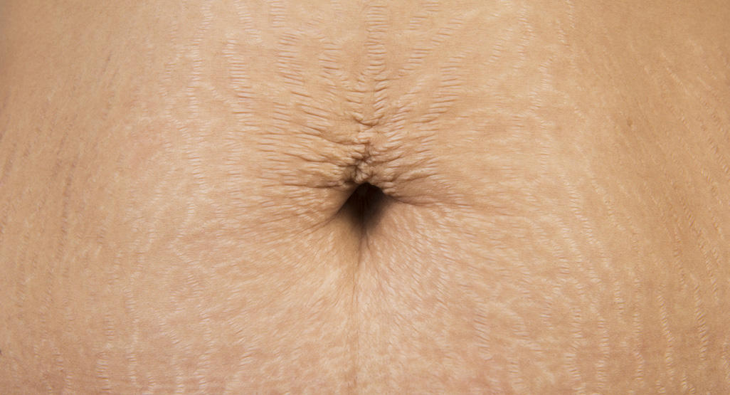 belly button on a belly filled with stretch marks