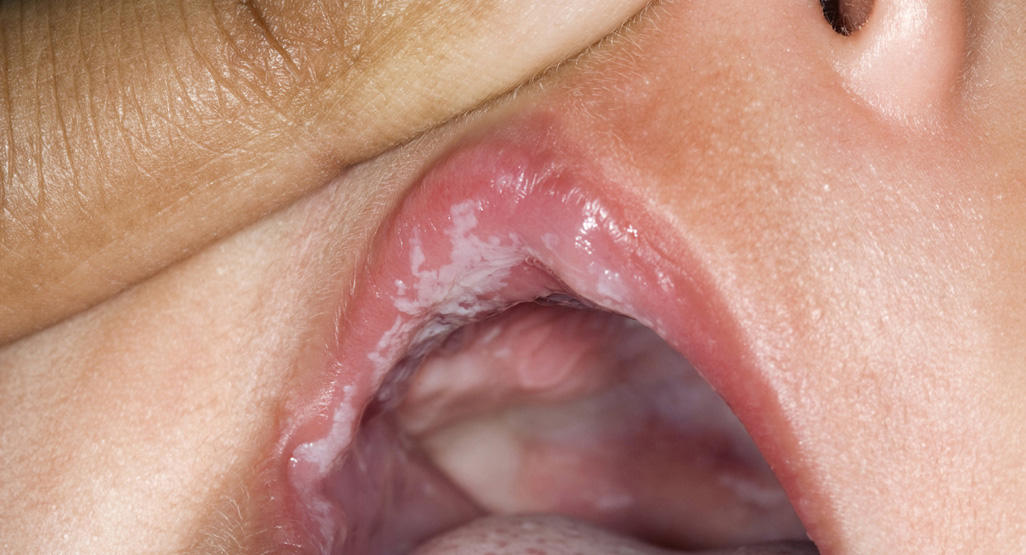 child with white mucus on tongue and upper lip