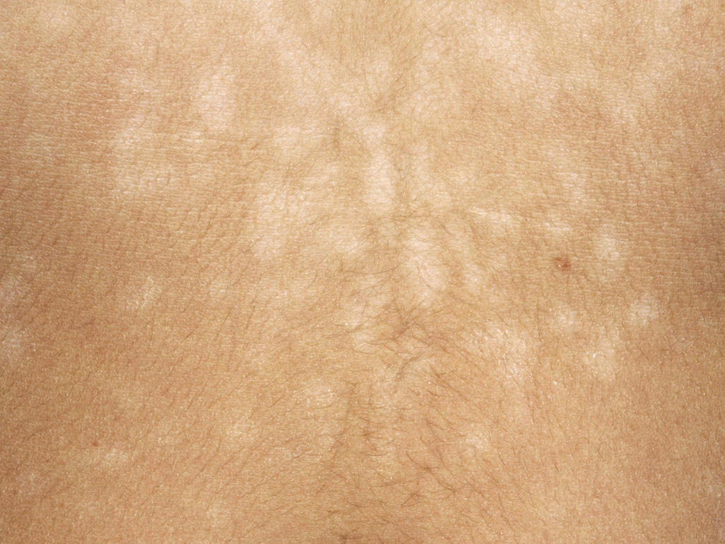 skin with white patches