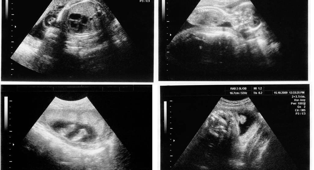 four ultrasound images