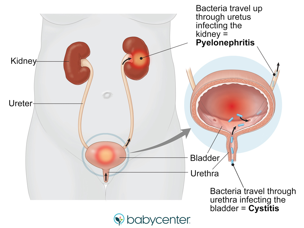 illustration showing urinary infections in a pregnant woman