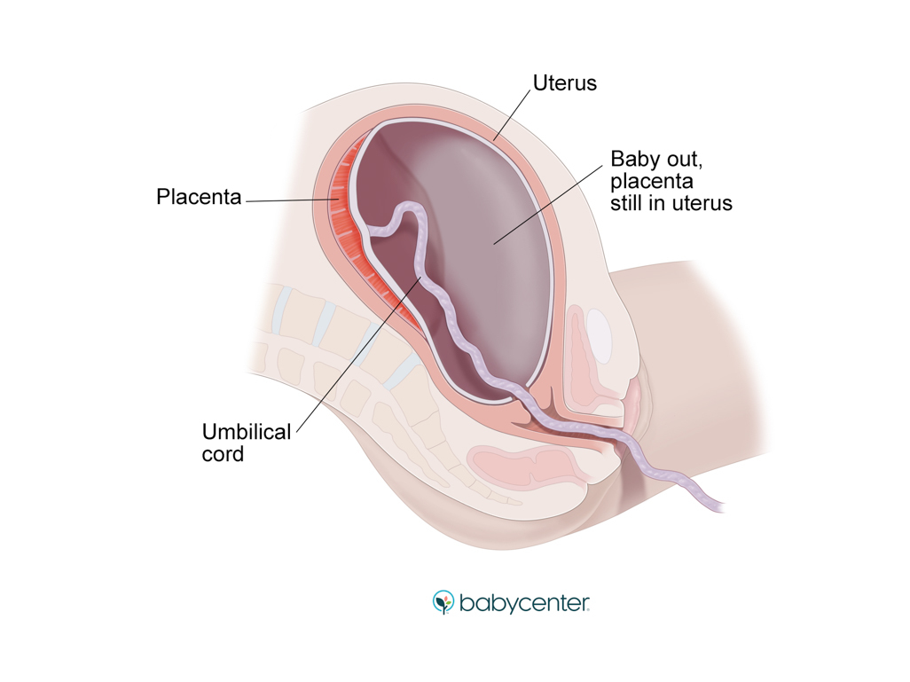 medical illustration showing uterus after delivery