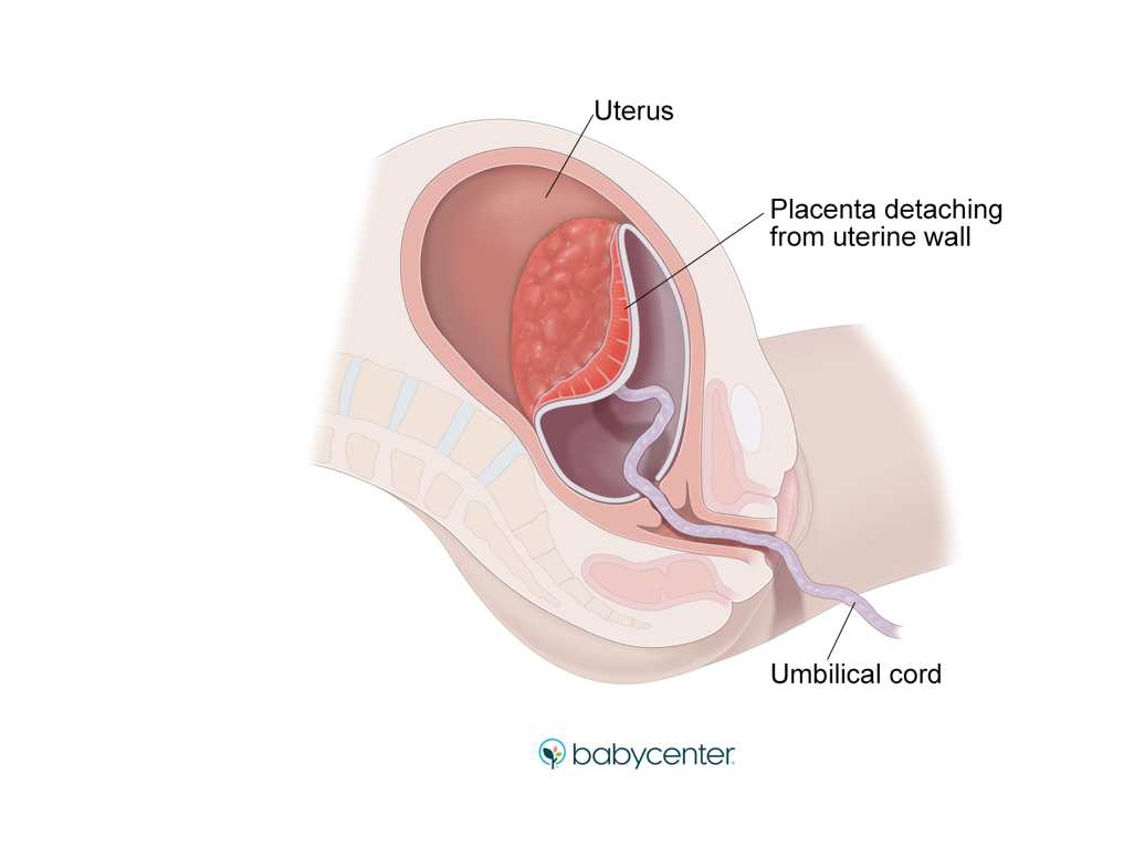 medical illustration showing placenta detaching