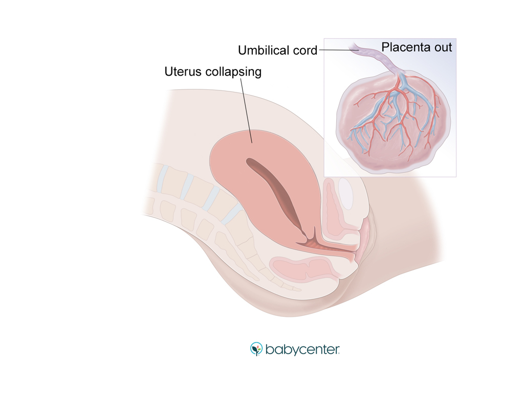 medical illustration showing uterus contracting