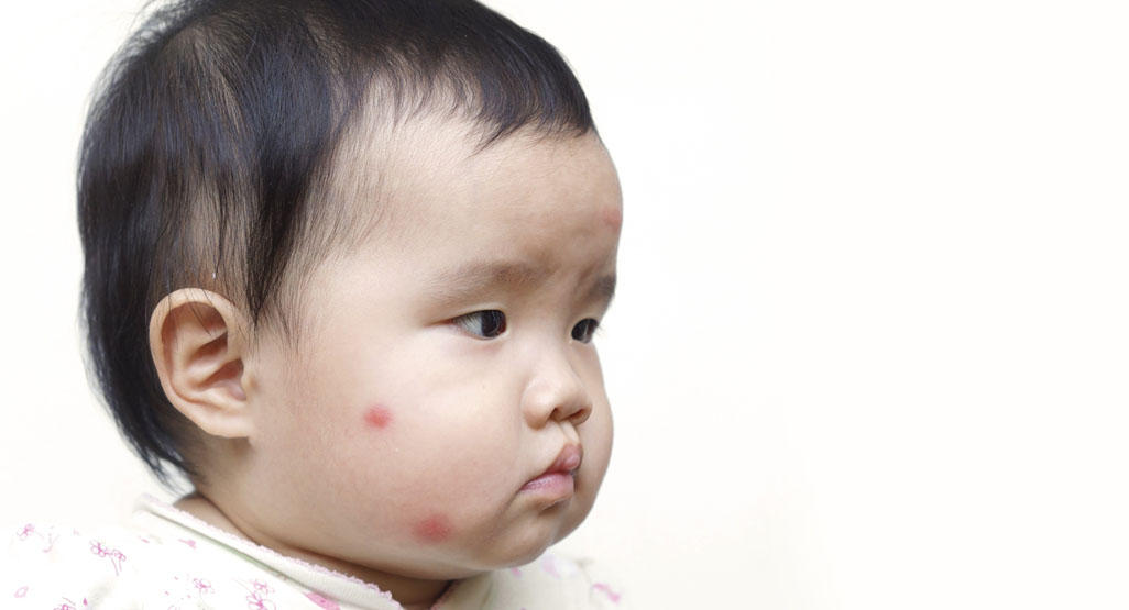 baby's face with two red bumps